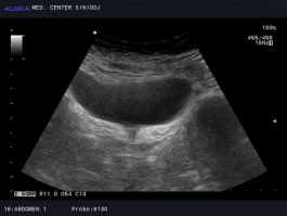Ultrazvok mehurja - lijakasto oblikovan iztočni del mehurja, urinska inkontinenca